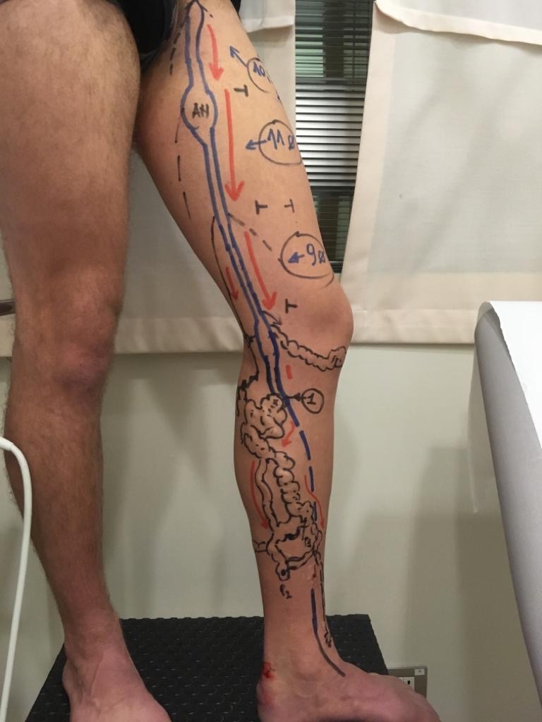 Esempio di mappaggio pre-operatorio 